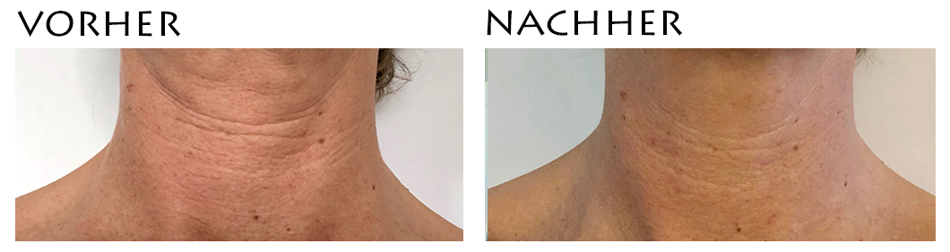 Radiofrequenz vorher nachher 1